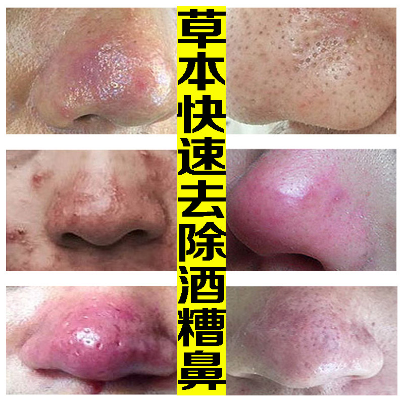 酒糟鼻软膏_酒糟鼻修复红鼻子鼻螨净去草莓鼻除螨虫粉刺红血丝鼻赘酒