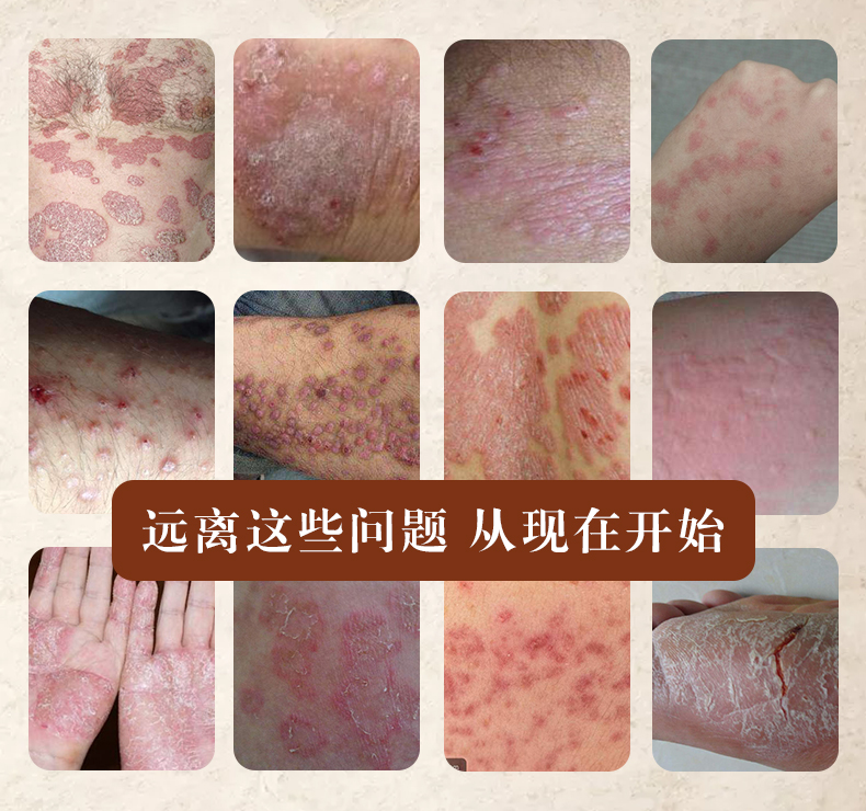 湿疹 无激素_成人慢性顽固反复神经性湿疹特效皮炎肤过敏止痒霜肛周无