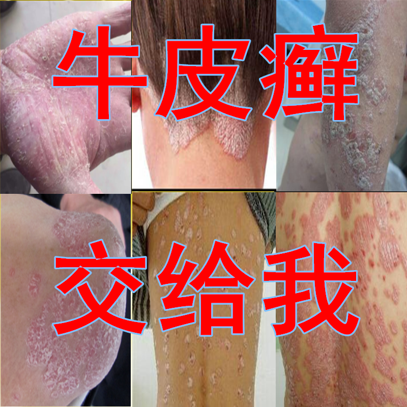 皮肤病专用治疗牛皮湿疹霜癣藓外用药膏阴囊真菌感染手癣止痒去根