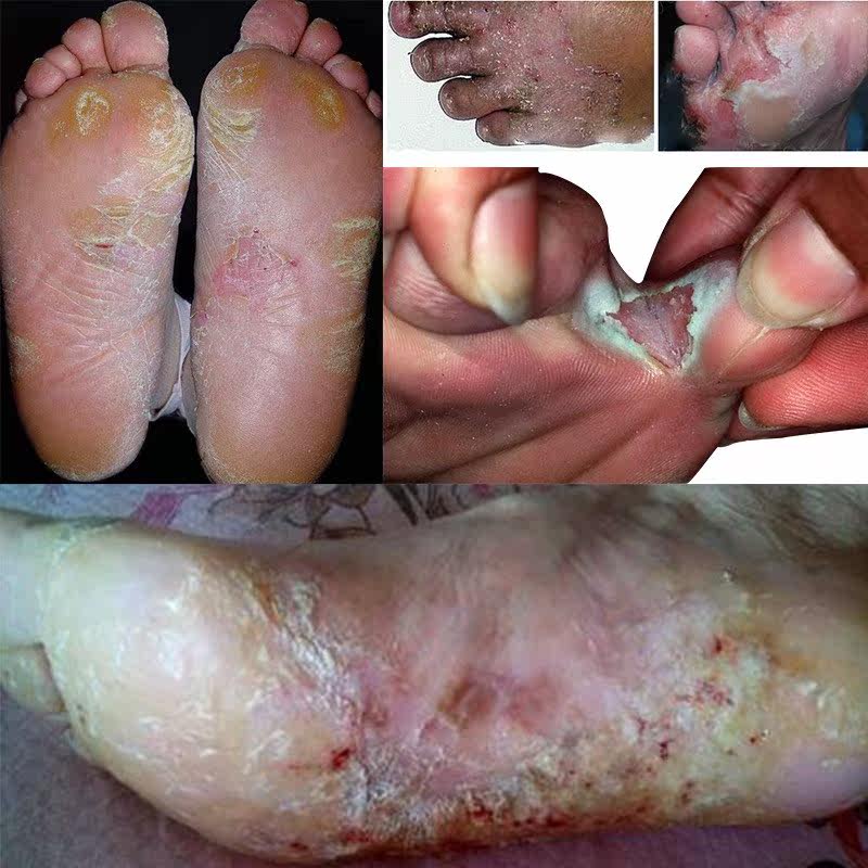 热销治脚臭药_烂脚丫脱皮糜烂水泡型止痒治脚痒喷剂去除脚臭膏药优惠