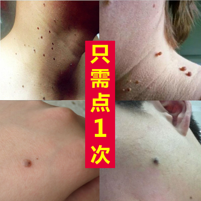 专用肉刺瘊猴子去除颈部脖子腋下肉粒丝状尤皮赘扁平尤膏灵特效液