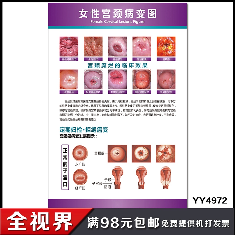 女性宫颈病变图教育挂图 宫颈糜烂临床效果海报 妇科健康检查贴纸