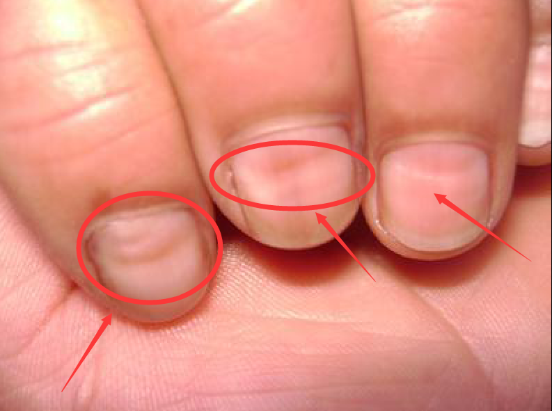 5.指甲凹陷:"肝主筋"这是一个在中医学上极为传统的一个说法.