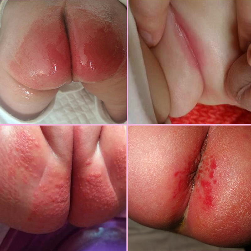 pp霜护臀膏_红股抑菌乳膏婴儿pp护臀膏湿痒大腿淹软膏宝宝红屁股疹