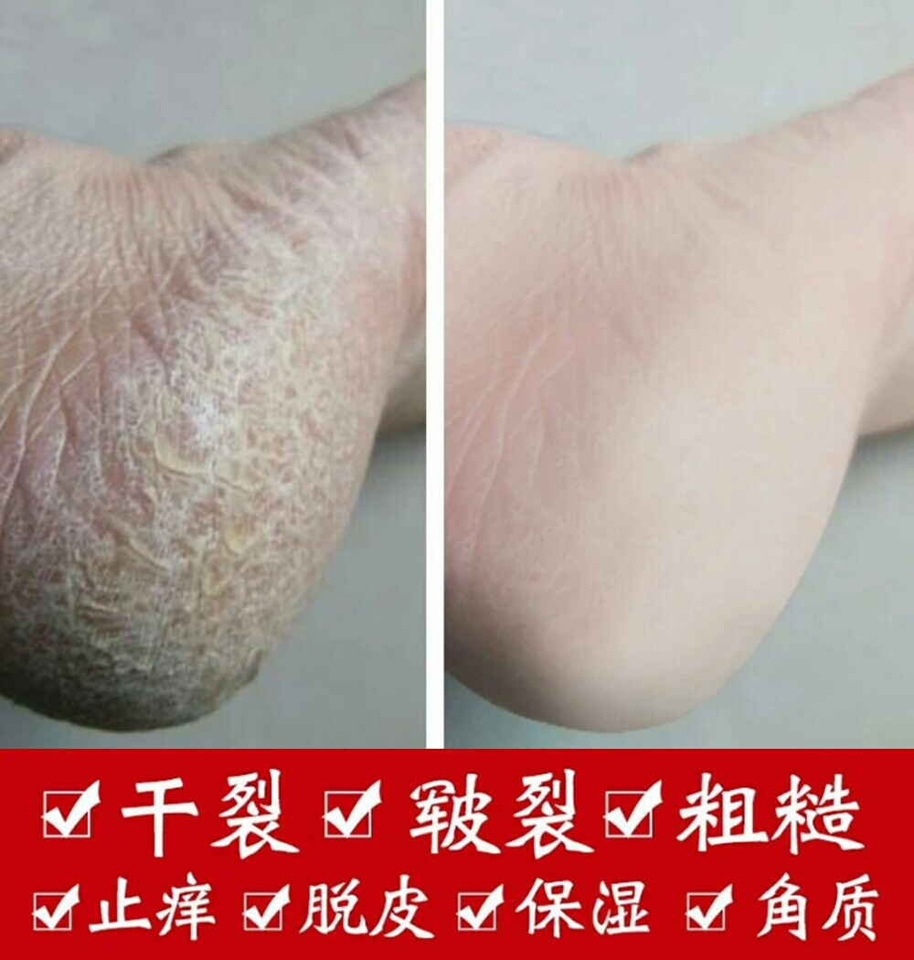 脚裂口 足干裂_防裂膏脚后跟干裂手裂膏脚开裂手脚裂手足裂口护手愈裂