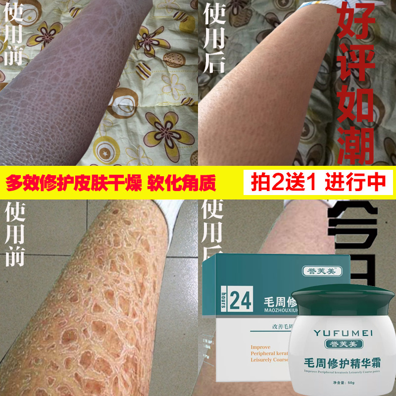 去鸡皮肤毛囊角质毛周角化疙瘩大腿部去除蛇皮干燥祛鱼鳞身体乳