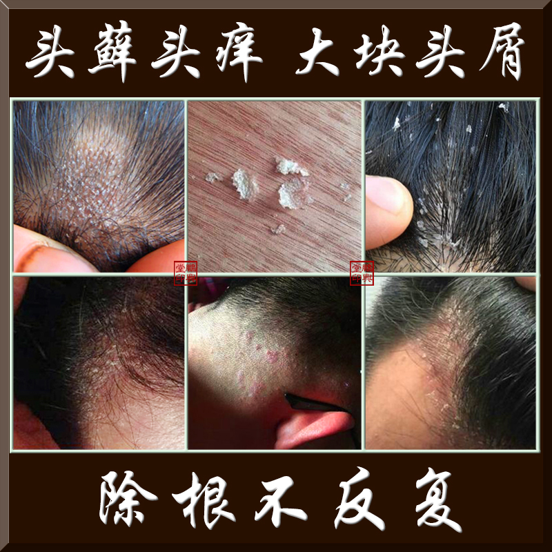 头康宁去屑神器止大块头皮藓疙瘩癣红痘脱发止痒软膏清洁露洗发水