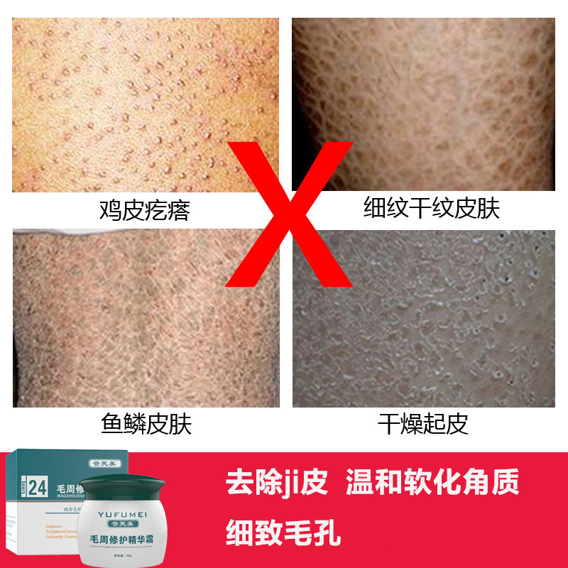 去鸡皮肤霜去鸡皮疙瘩修复毛周角化毛囊角化鱼鳞皮肤蛇皮肤膏大腿