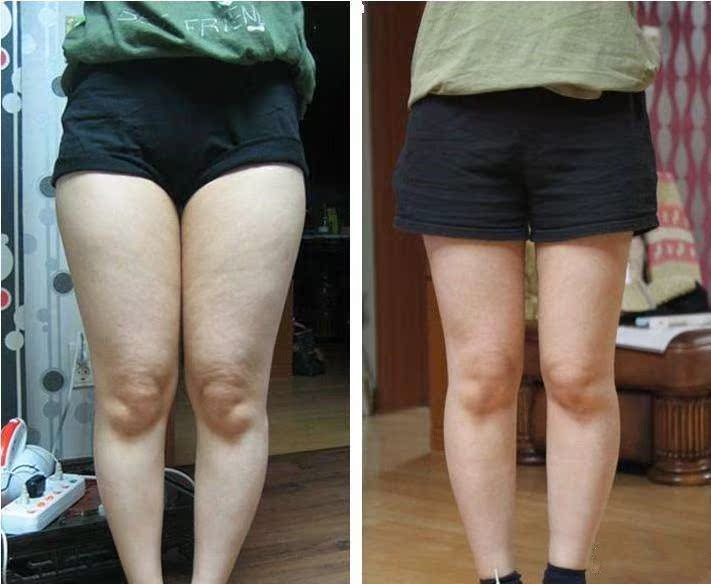 一折瘦小腿肌肉 顽固型_瘦腿神器顽固型大腿小腿学生告别大象腿粗腿