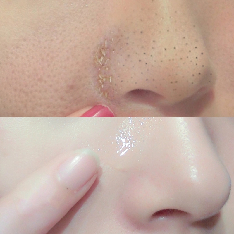 蒂欧尼电动吸黑头神器 去粉刺收缩毛孔清洁器脸部洁面导出去螨虫