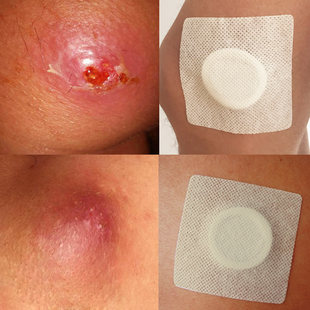 拔毒膏拔毒贴 火戒子 坐板疮 拔脓膏 贴膏正品 买2送1