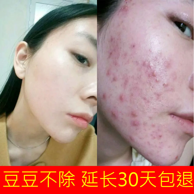 青春痘祛痘印痘痘产品膏去痘淡化痘印收缩毛孔伊芝净雪肤膏