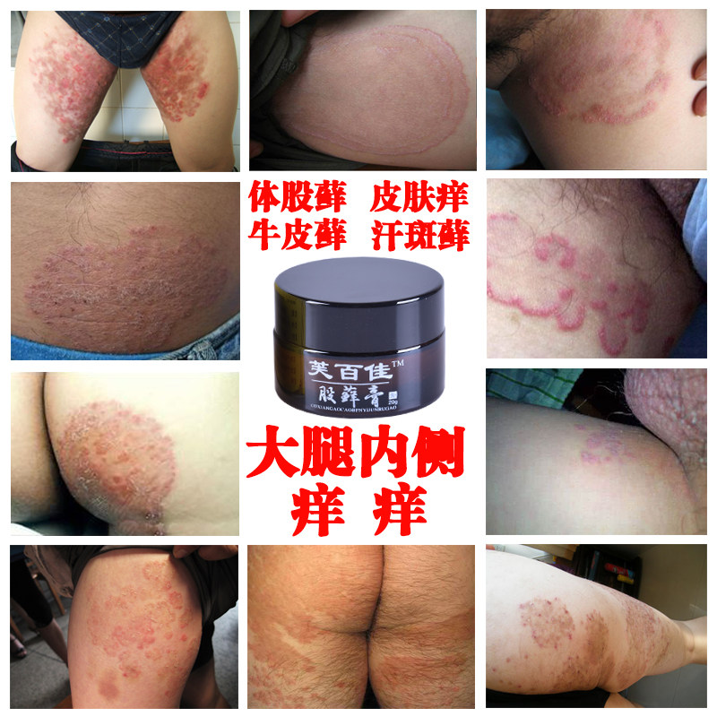 男女大腿根内侧股藓皮肤痒大腿内侧痒屁股股沟藓通用外用止痒软膏