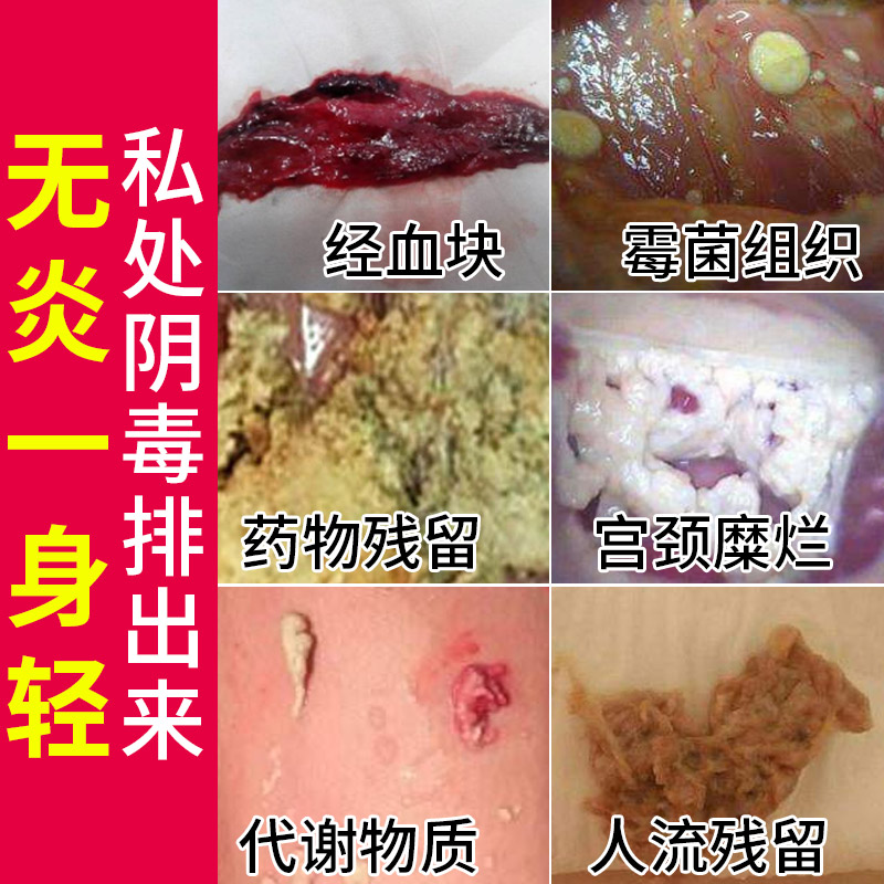 妇科凝胶重度宫颈凝胶 霉菌性白带异味私处护理