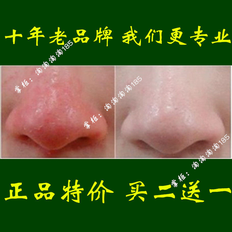 酒糟鼻 红鼻子_去除酒糟鼻治疗液修复凝胶红鼻子特效正品螨虫药酒渣鼻