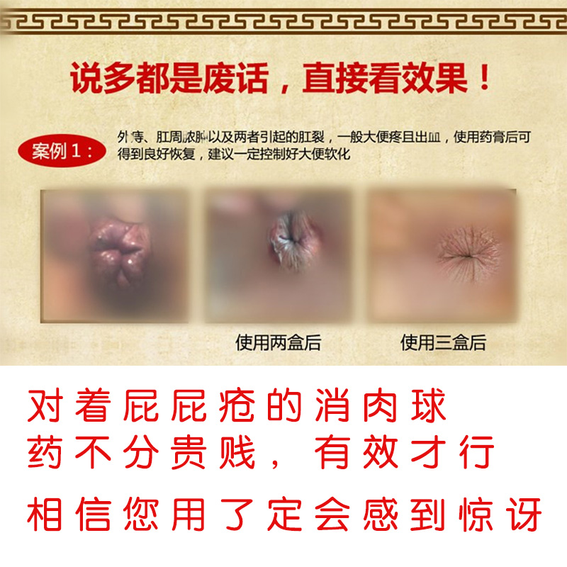 治痔疮药膏消肉球术后肛裂治疗特效去便血止痒非日本进口内痔外痔 $