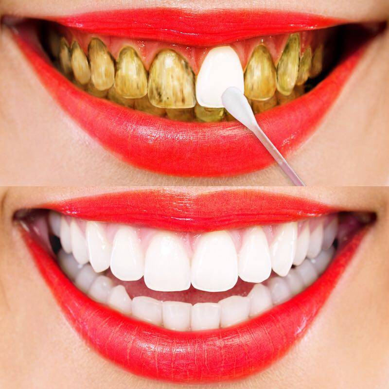 洗牙粉 美白 黄牙_牙齿美白洗牙粉白牙黄牙去牙渍