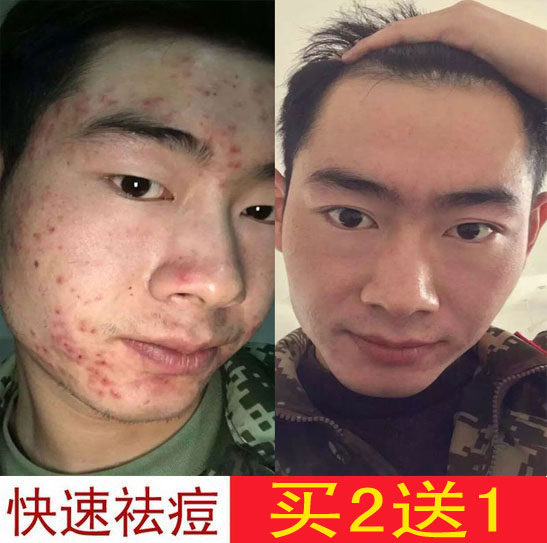 热销去痘痘 祛痘膏_脸上长痘痘粉刺暗疮膏男士去闭合性痤疮淡化痘印