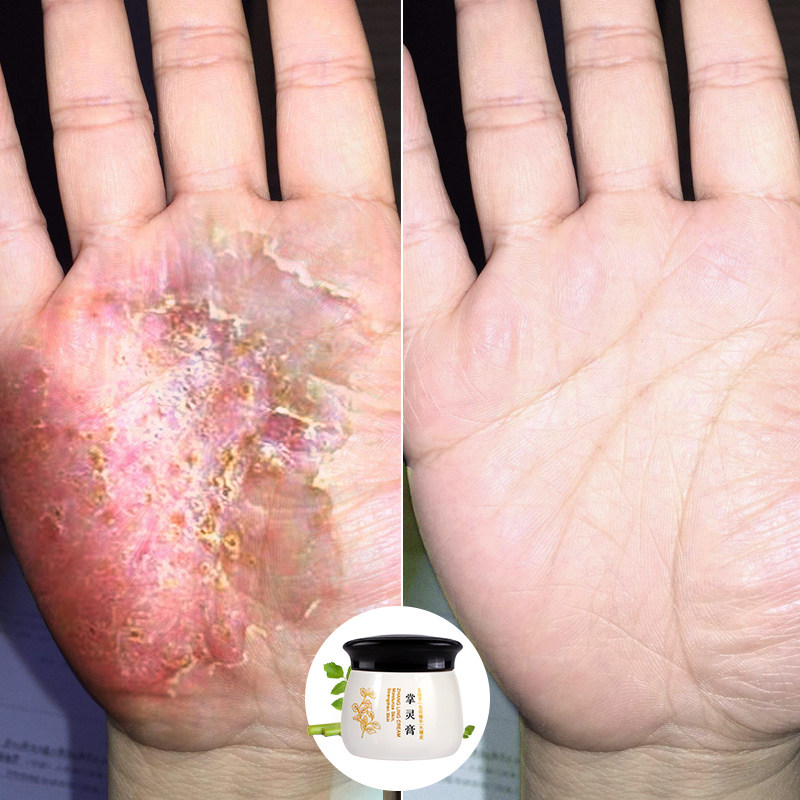 朴安堂掌灵膏 手足皴裂手脱皮手部汗疱水泡防冻皴裂膏