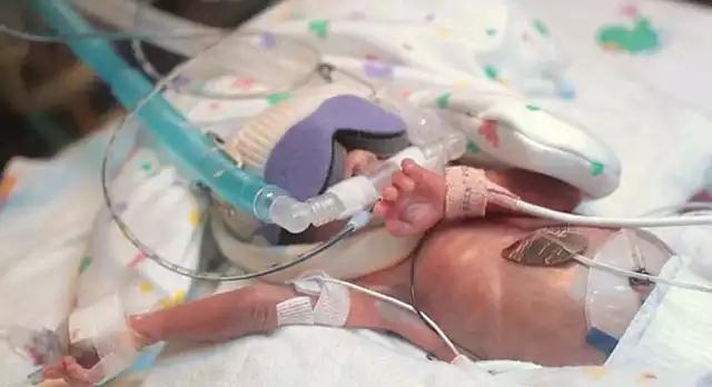 3斤的早产儿出现奇迹,出院的样子超萌!