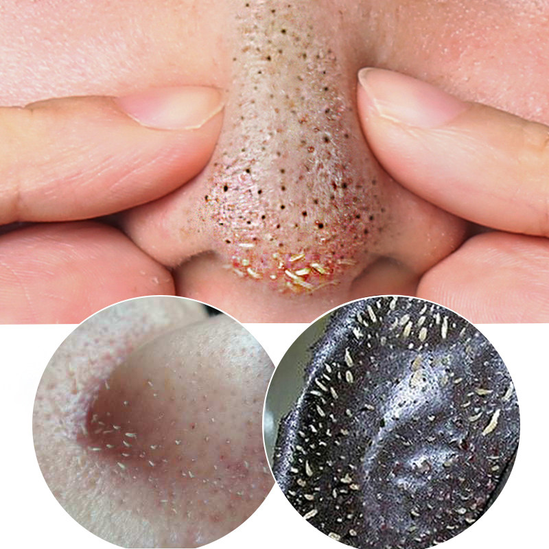 去黑头面膜男 吸黑头