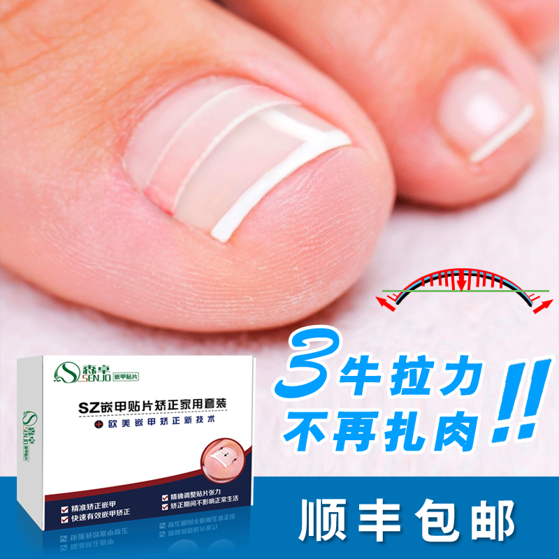 甲沟炎_甲沟矫正贴片脚趾甲矫正器脚指甲长肉里丝嵌甲贴校正修正器炎