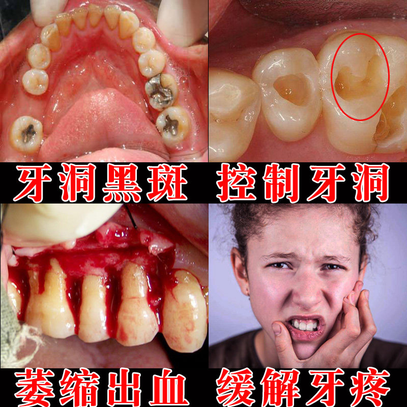 牙粉_蛀牙修复虫牙洞黑斑治牙疼去牙痛特效防儿童牙膏孕妇牙龈肿痛
