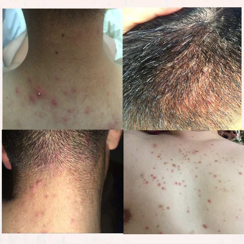 治疗毛囊有炎脓包痤疮私处杀菌头皮背脸部痘痘去除鸡皮肤疙瘩中药