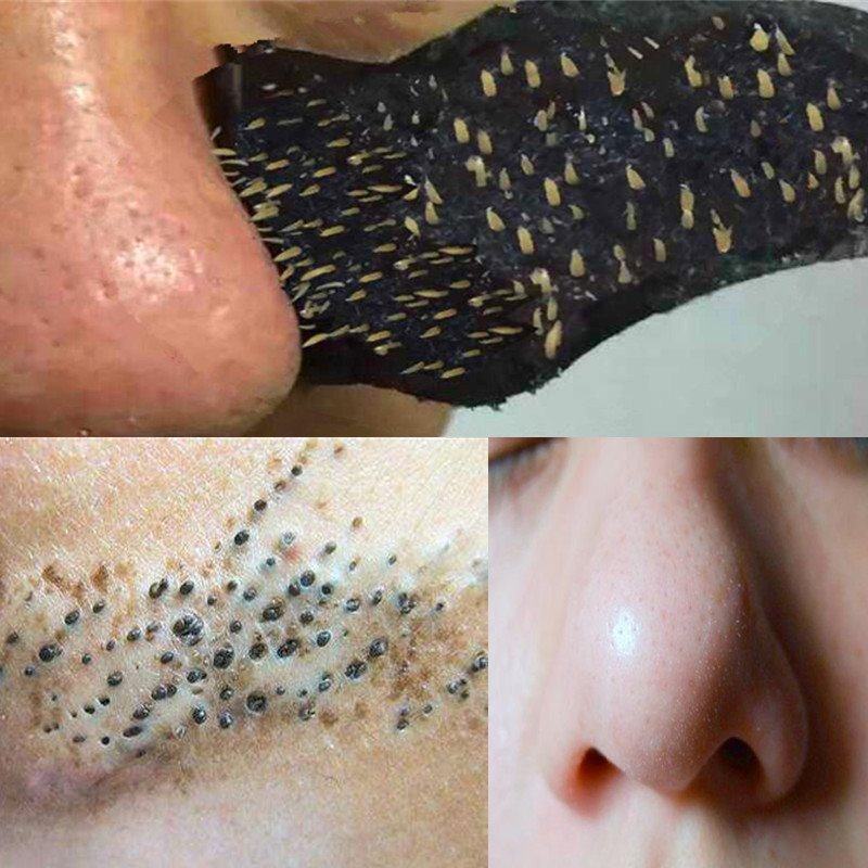 去黑鼻头粉刺撕拉面膜