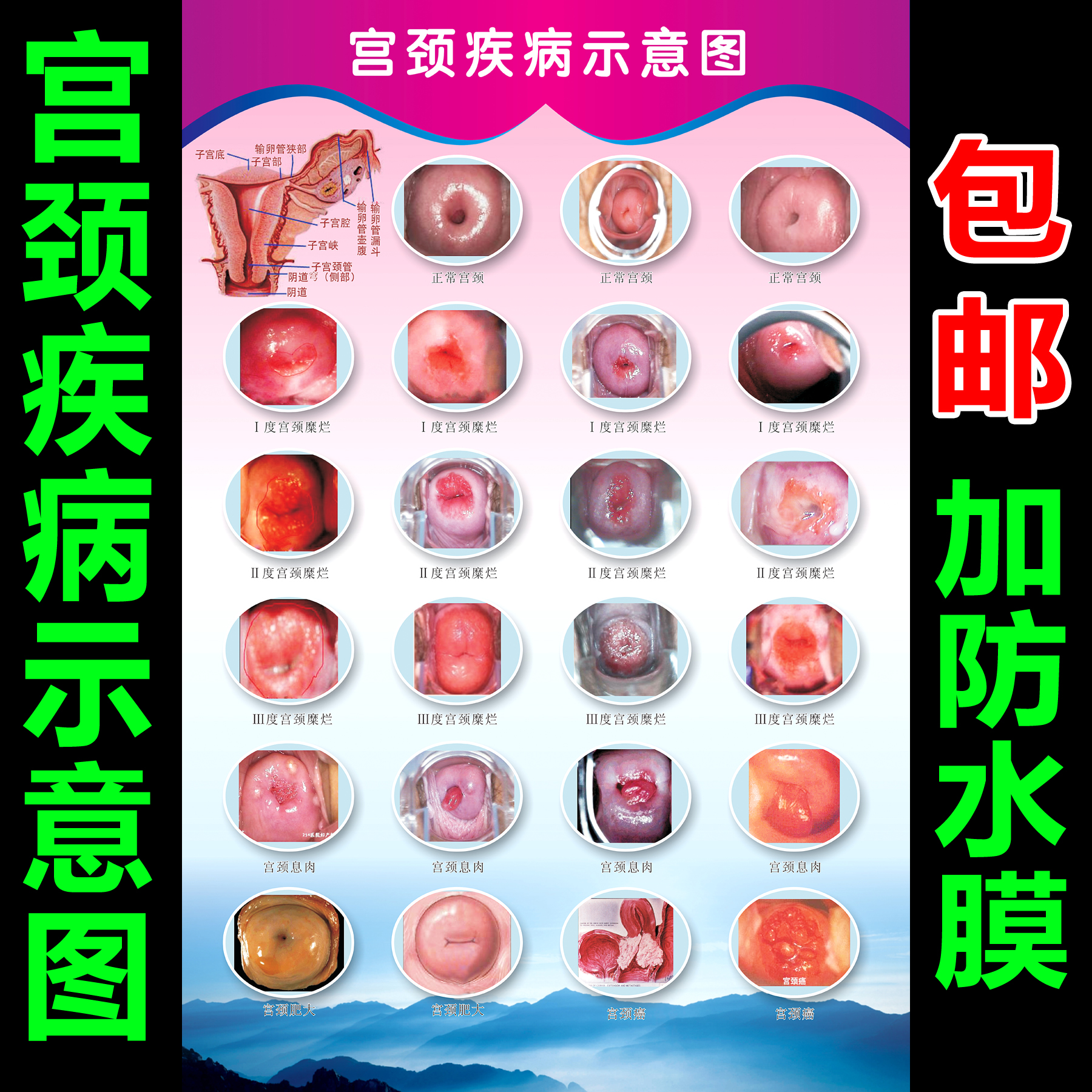 722海报印制展板写真喷绘贴纸201妇科解剖图3宫颈糜烂诠释图