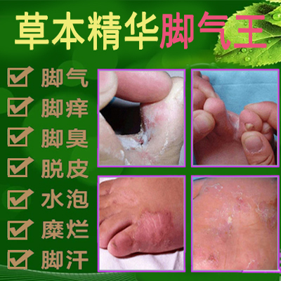 厂家直销通用去脚气王喷剂特效除脚臭脚痒水泡脱皮糜烂脚丫脚出汗