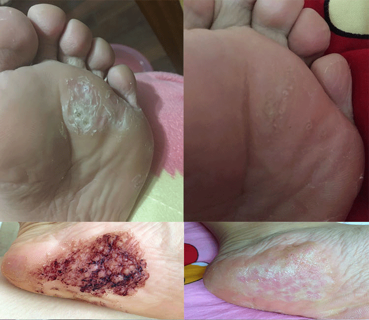 治疗汗疱疹水泡手脱皮手部湿疹止痒药膏成人外用孢疹手痒手指手癣