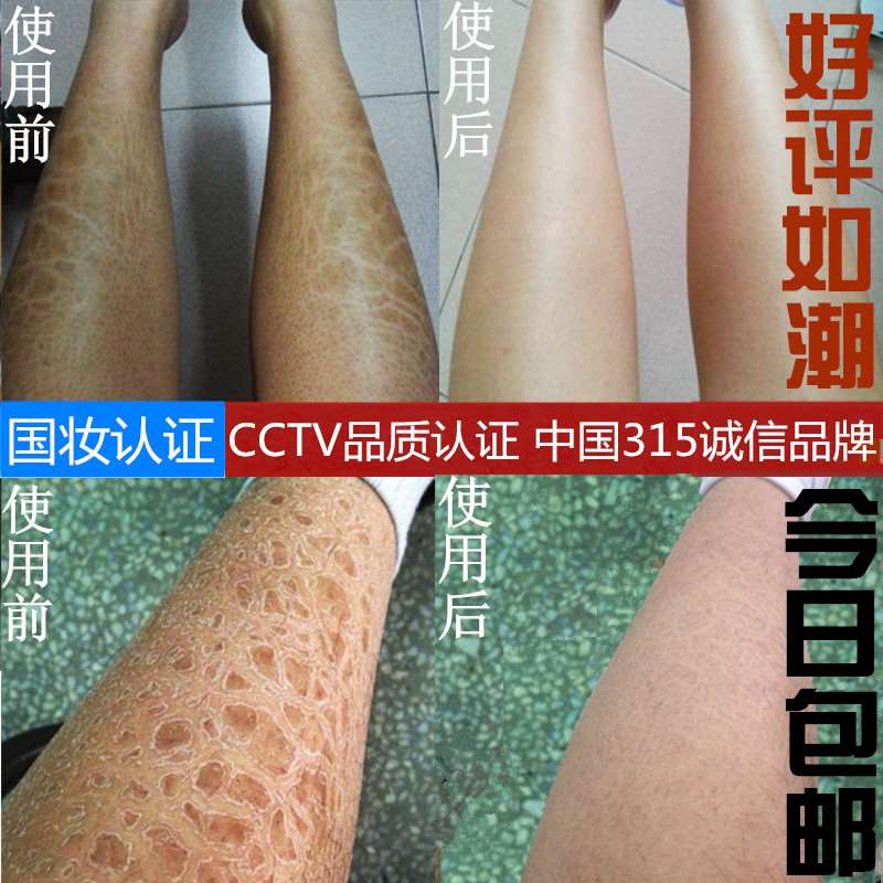 物华本草去除鱼鳞腿蛇鸡皮肤纹路角质美白保湿滋润干脱屑身体乳