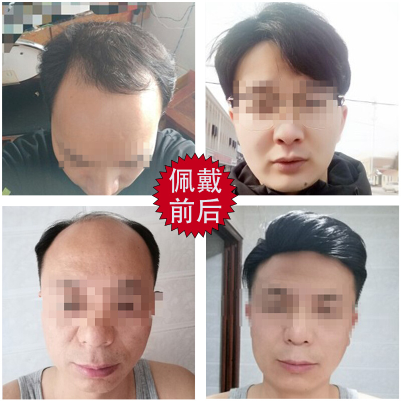 定制正品男士假发短发帅气韩版头顶补发片偏分秃顶前额中老年男式 - 图0