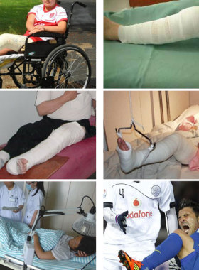 膝关节固定支具腿部下肢