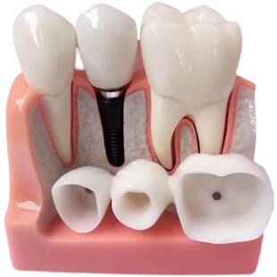 4倍牙齿种植义齿修复可拆卸连桥牙冠种植钉牙科牙医解说模型摆件