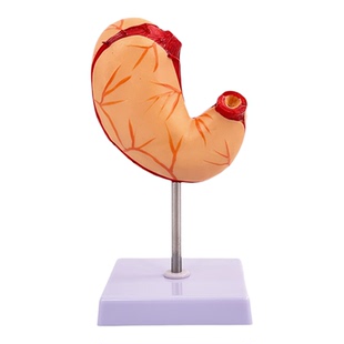 人体胃解剖模型 胃的病变模型 胃部疾病演示模型 病理胃 胃的穿孔