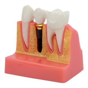 牙模型种植可拆卸口腔标准神经牙模修复体全口病理医患沟通模型