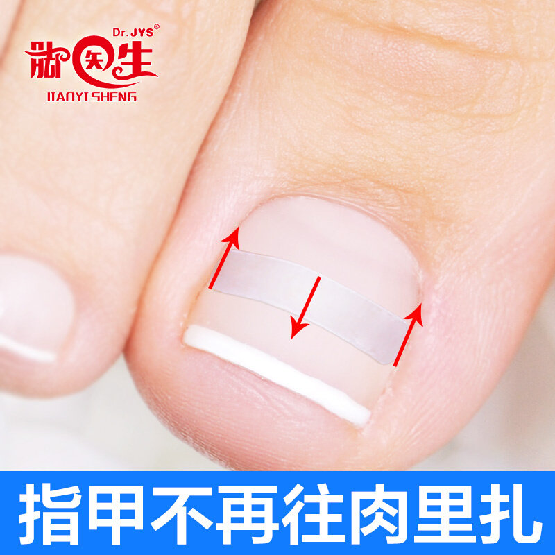 脚医生正甲贴片嵌甲拉拉专用甲沟红肿疼趾甲往肉扎矫正器套装神炎