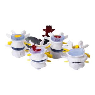 人体四队四阶段病理腰椎骨骼解剖椎间盘病变突出关节突出变形模型