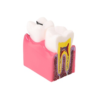 牙齿模型6倍龋齿对比模型 蛀牙演示模型剖面模型医患沟通教学模型