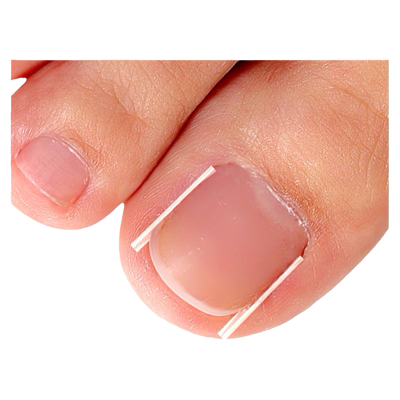 脚趾正甲贴神器专用填充垫炎