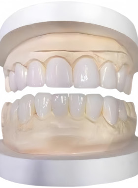登士柏灵犀瓷全瓷牙齿贴面牙贴片