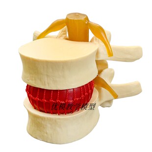 腰椎放大 腰椎间盘受压 演示模型 人体脊柱 脊椎骨 病理演示模型