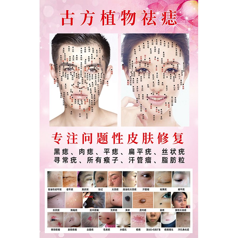 面部点痣图宣传图痣相图取痣祛痣祛斑点海报图男女面痣点疣广告图