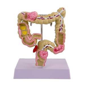 人体胃解剖模型 胃的病变模型 胃部疾病胃的穿孔演示模型 病理胃