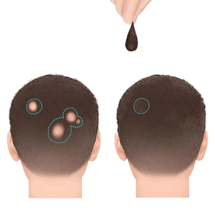 疤痕补发贴头顶秃斑伤痕秃顶专用假发贴片真人发丝生物头皮男女片