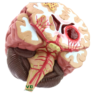 ENOVO颐诺脑卒中模型脑中风急救演示人体脑部疾病展示大脑解剖结构神经外科手术演示医生培训中老年健康讲座