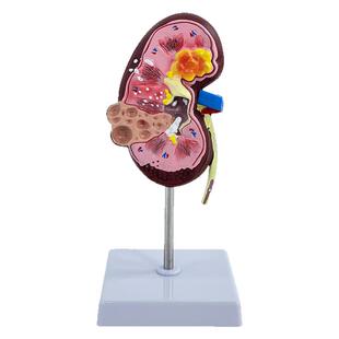 人体肾解剖模型 病理肾脏模型 正常肾部模型专业内脏器官医学教具