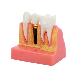 牙齿模型口腔教学幼儿园摆件牙龈修复种植教具可拆卸儿童全口牙模